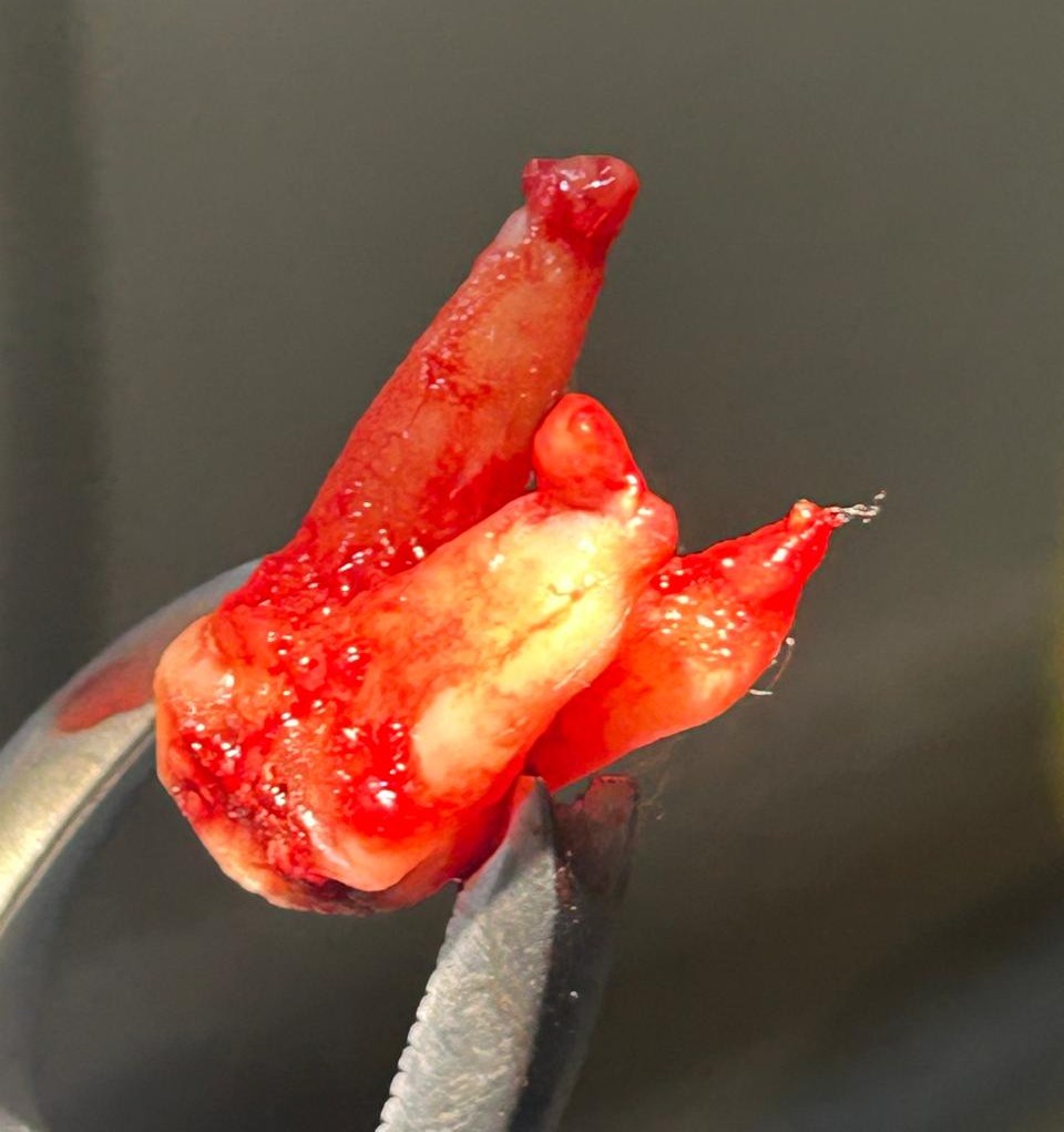 Dental extraction treatment